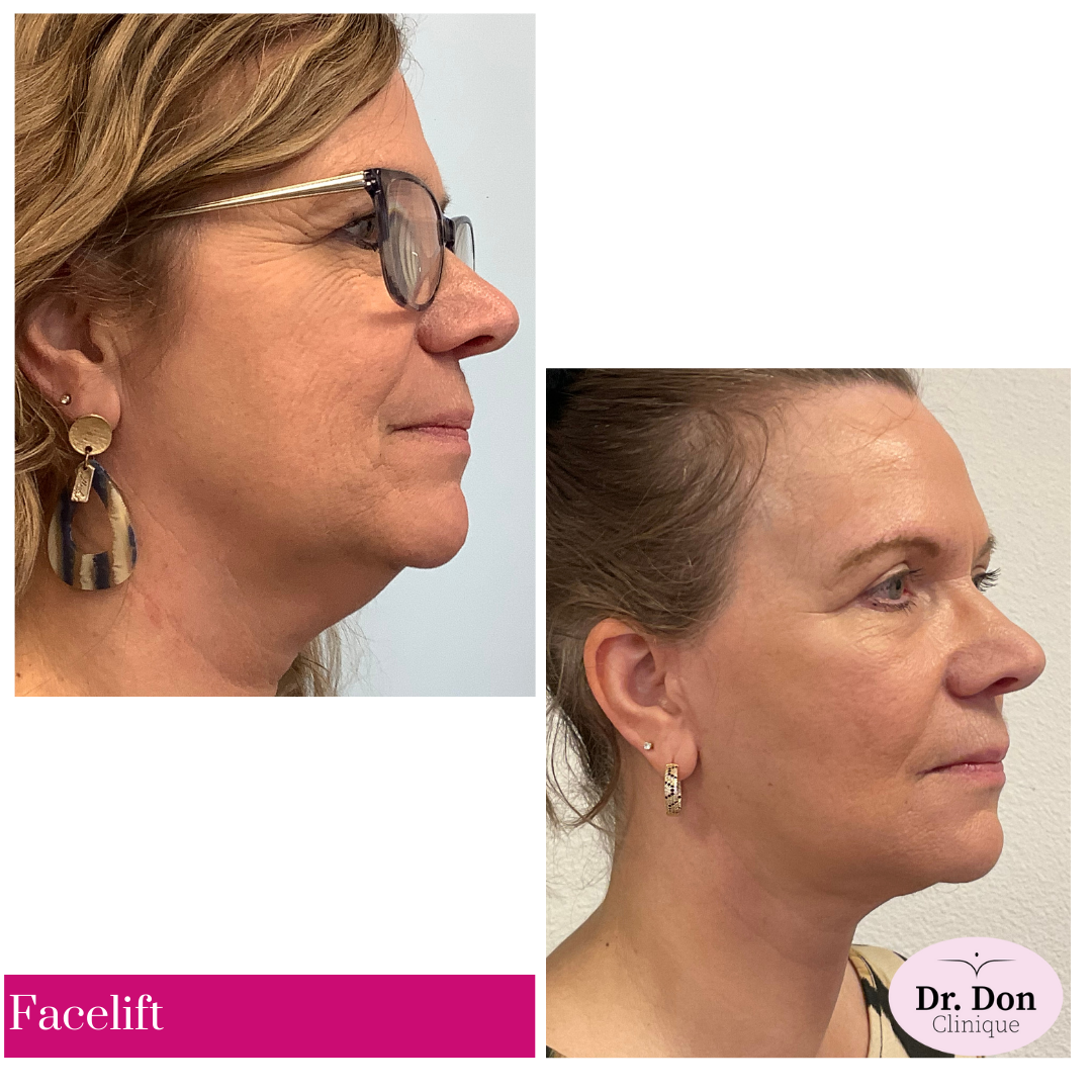 Facelift incl. uitgebreide halslift en bovenooglidcorrectie Facelift incl. uitgebreide halslift en bovenooglidcorrectie
